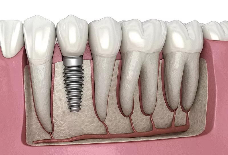 dental implants specialist