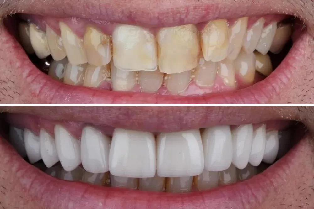 Teeth Whitening Treatment Results