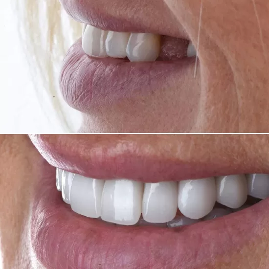 before and after treatment teeth