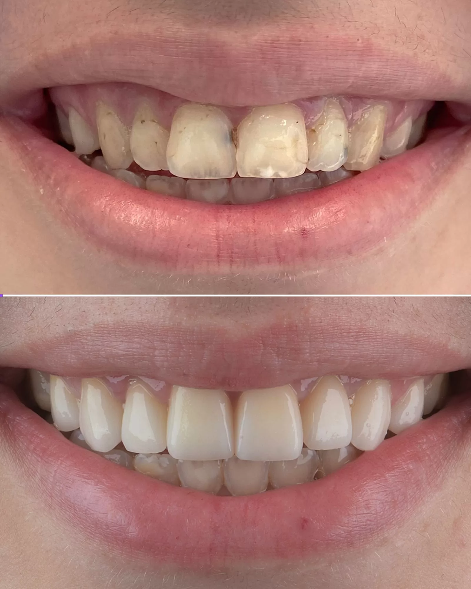 Damaged Teeth Full Restoration Before After