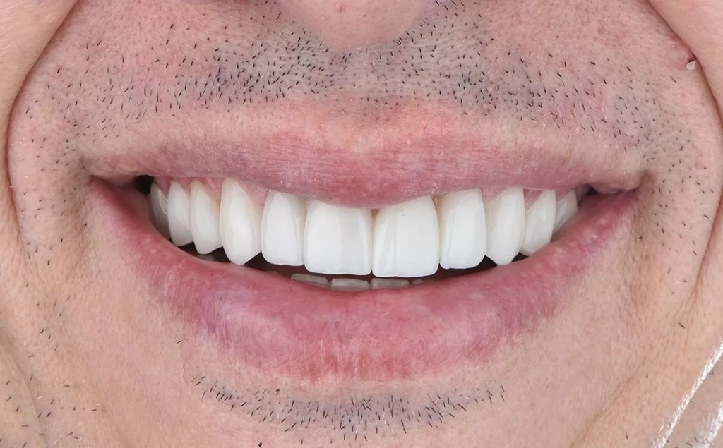 after treatment teeth