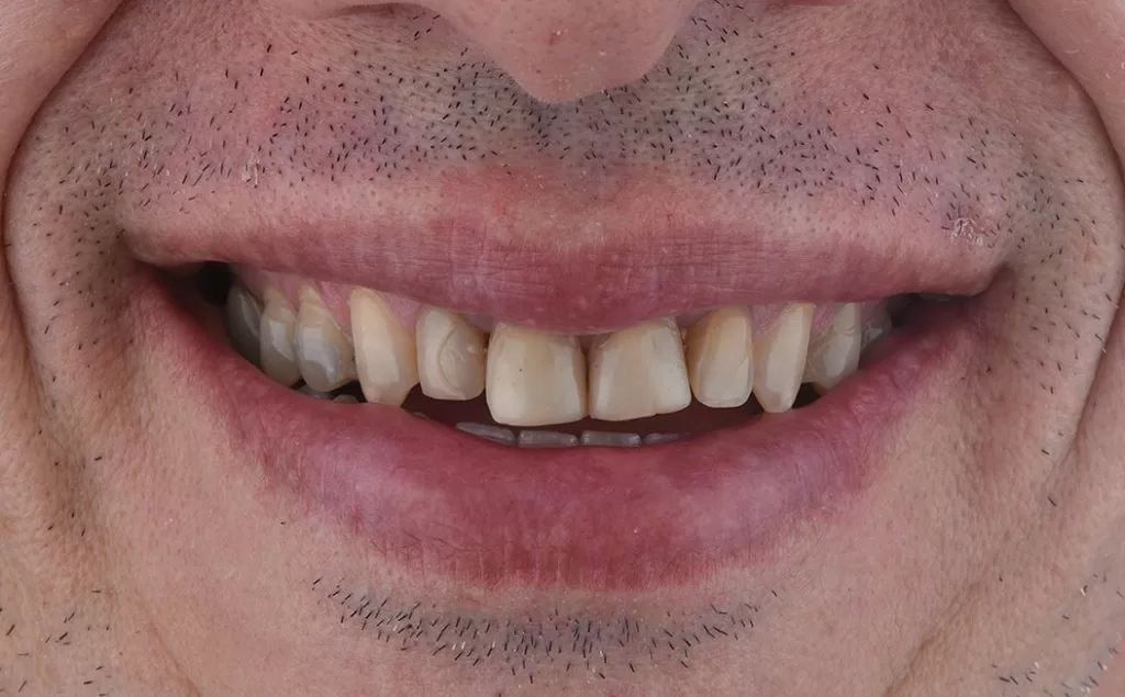 before treatment teeth