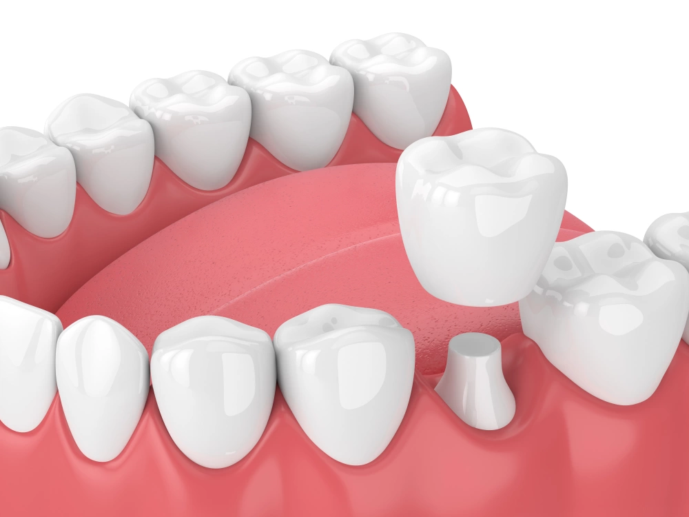 Dental crown placement procedure illustration