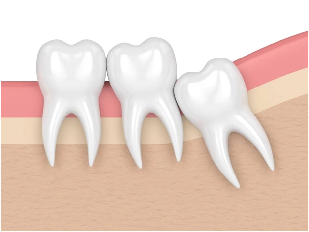 Wisdom-Tooth