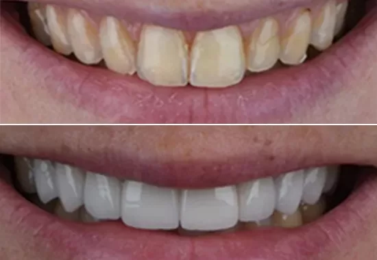before and after treatment