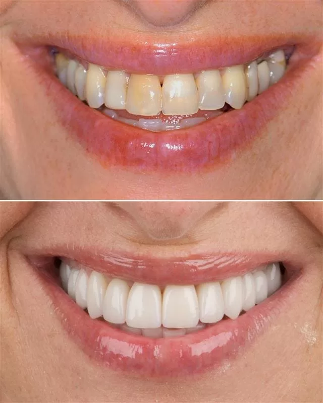 Eliane Dental Before After