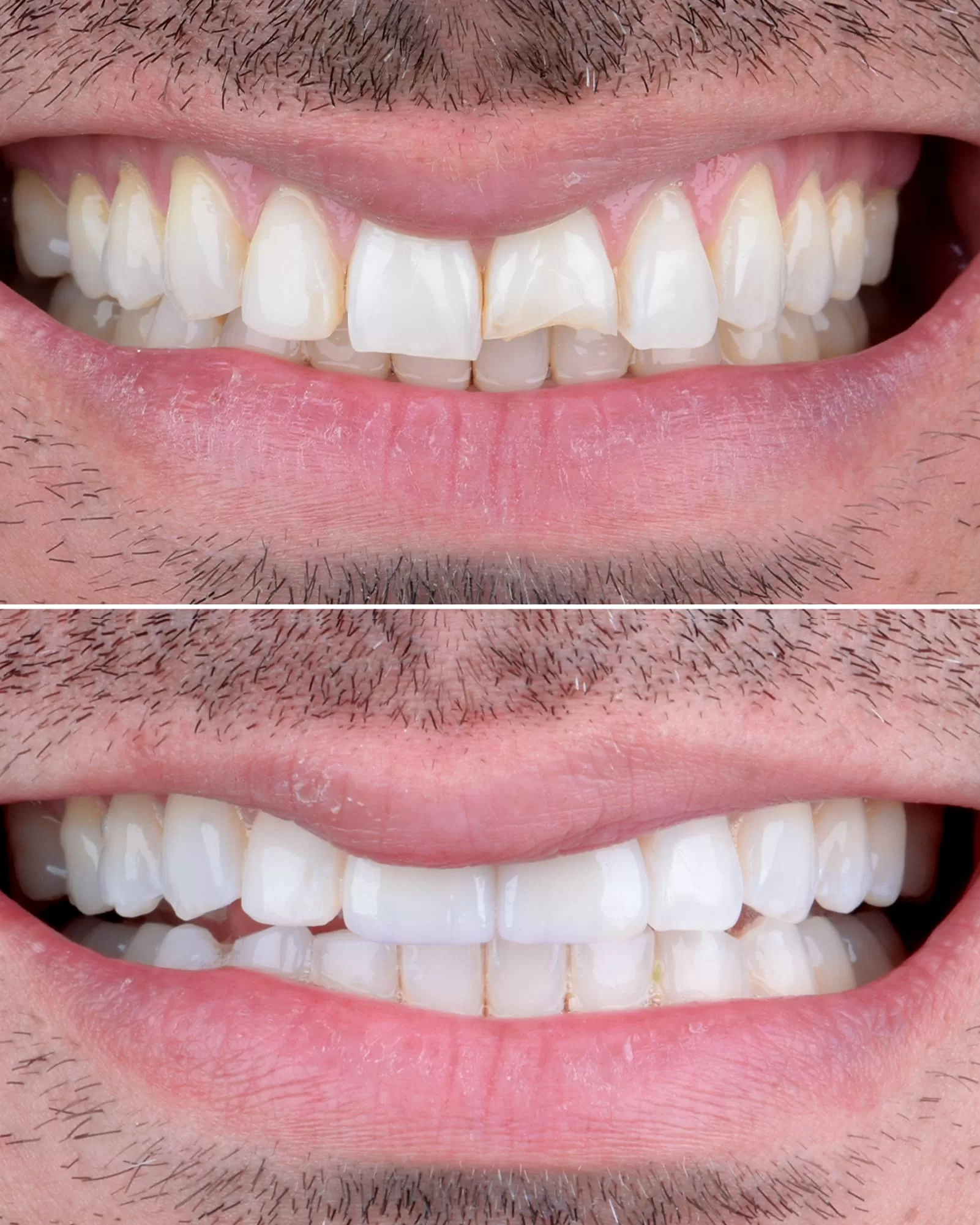 Smile Correction Before After