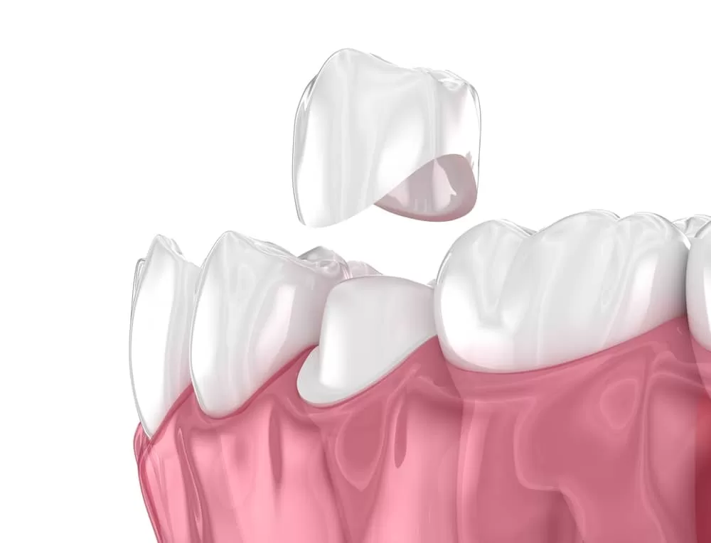 dental crown treatment