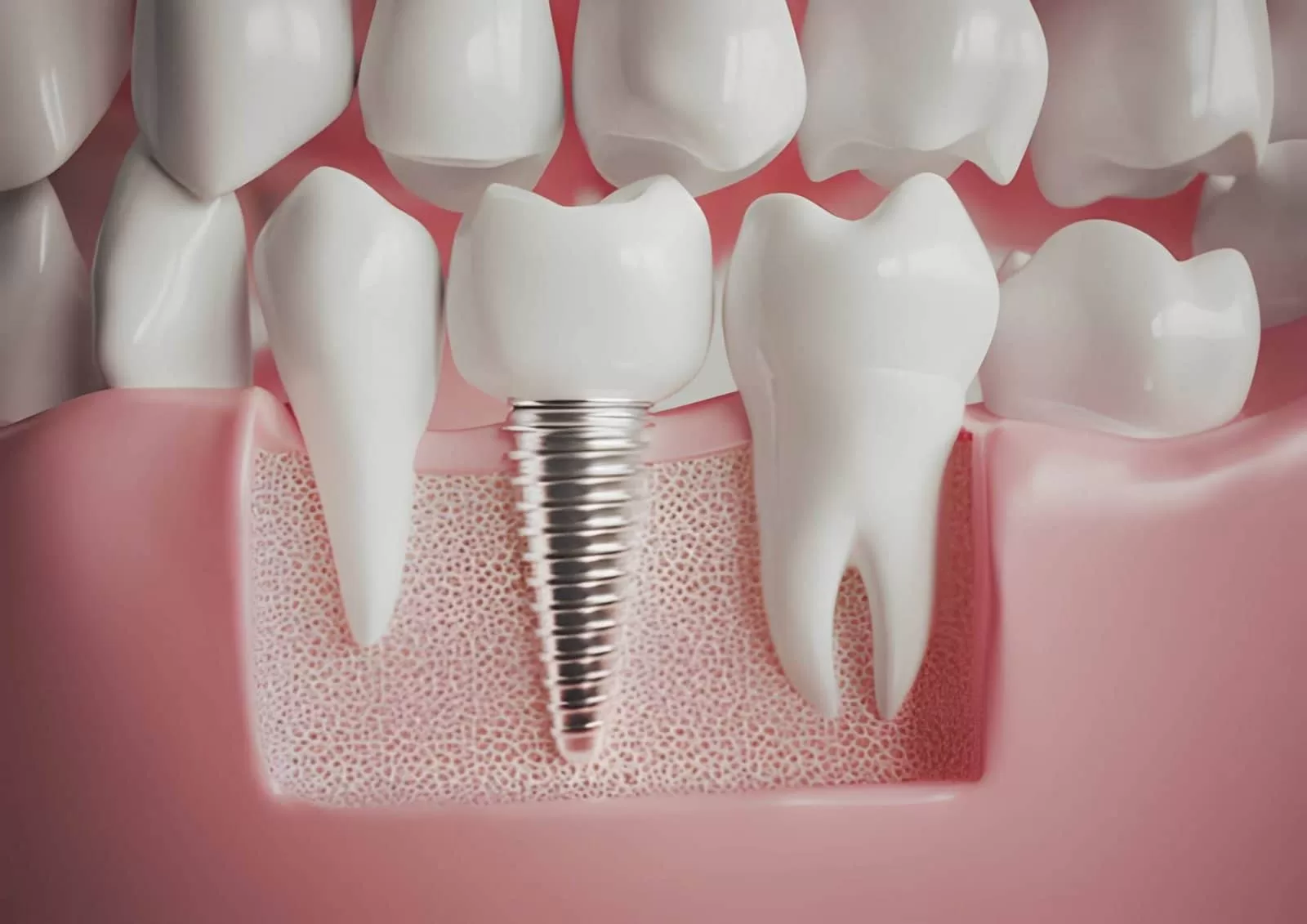 dental implants