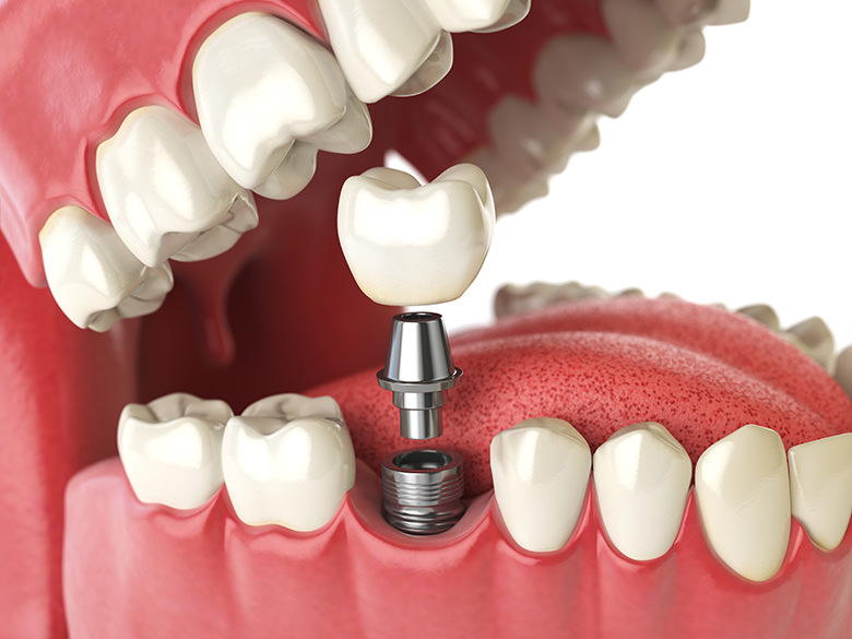 Miami-dental-implants