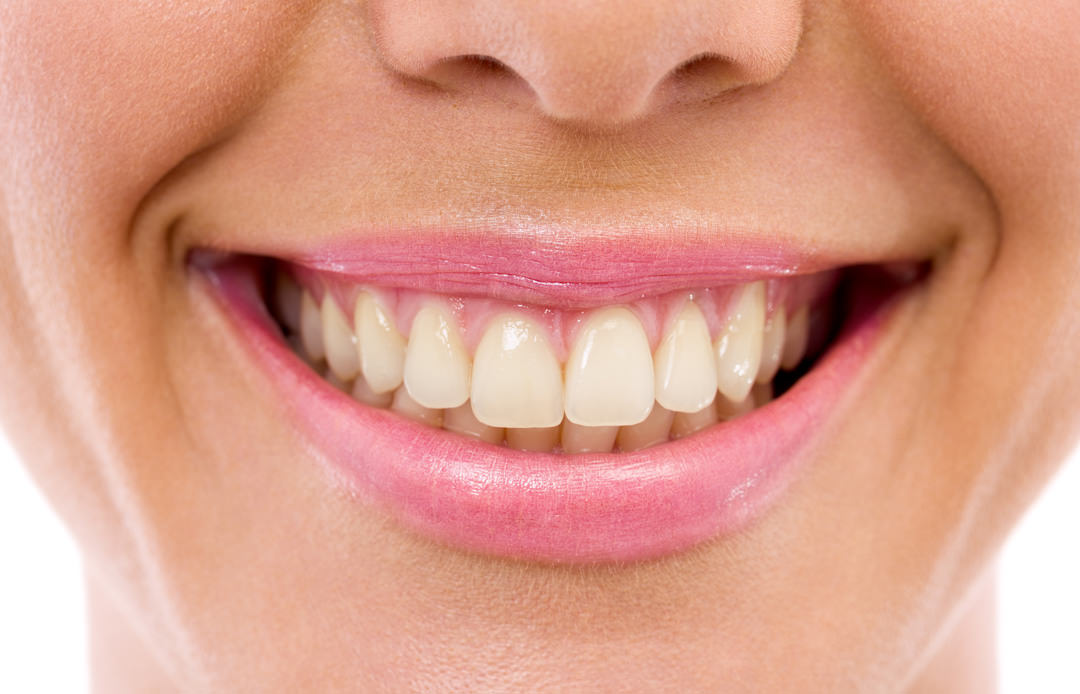miami-teeth-whitening-1