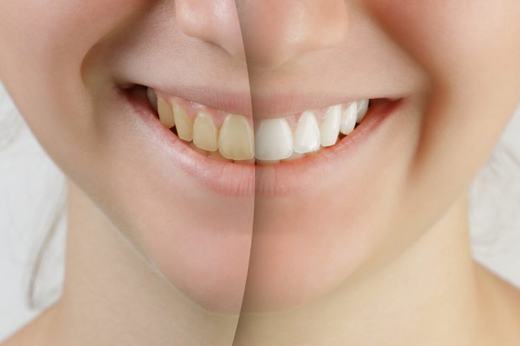 miami-teeth-whitening