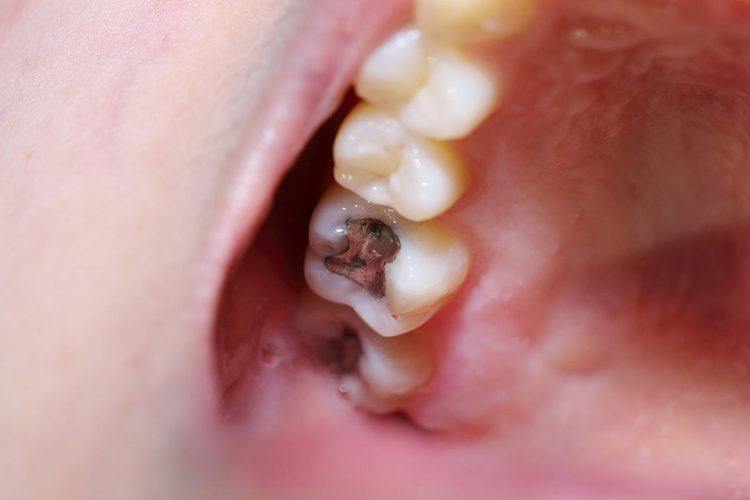 Mercury and Amalgam mercury-and-amalgam