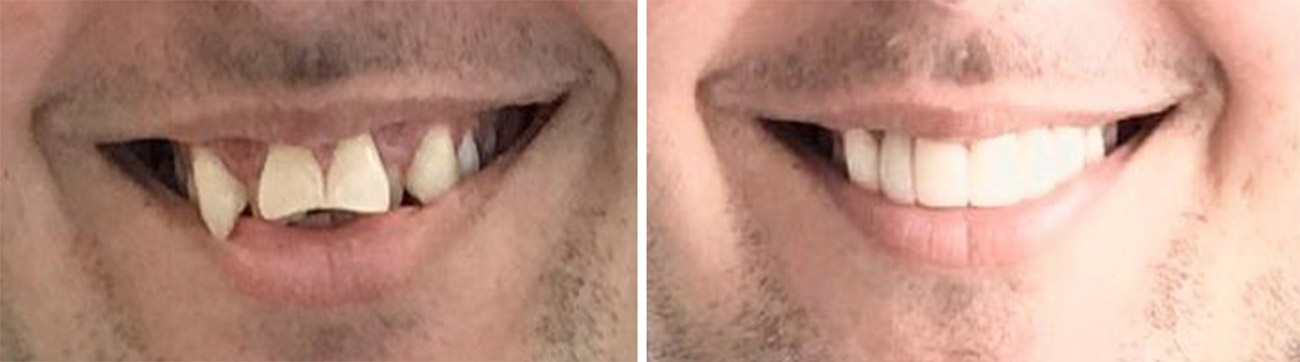 before-after-veneers-sharp-web