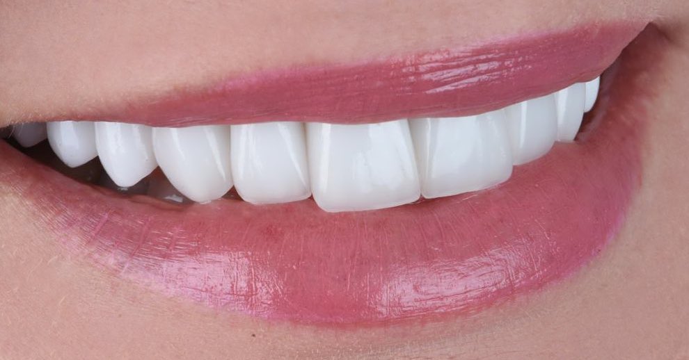 Porcelain Veneers Miami, FL | Sharp Dentistry & Associates