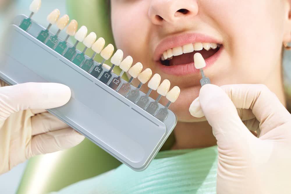 Porcelain Veneers