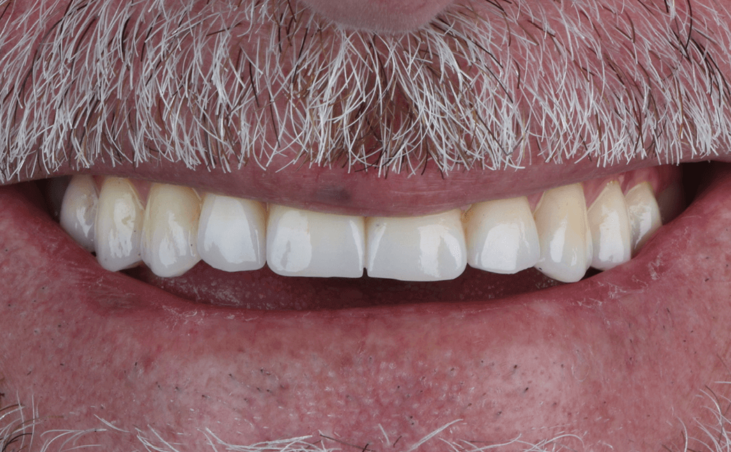 After image