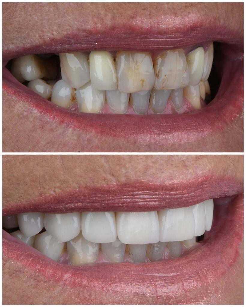 Dental Implants Miami