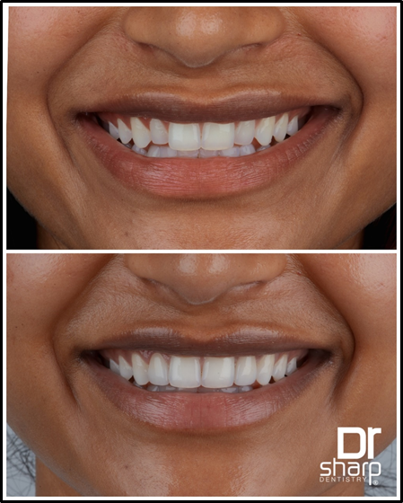 Porcelain Veneers Miami FL