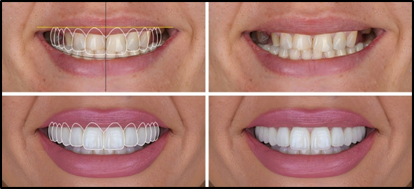 porcelain veneers mimic