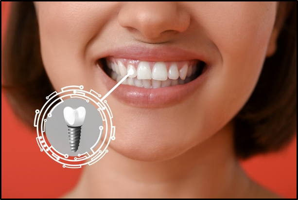 dental implants miami