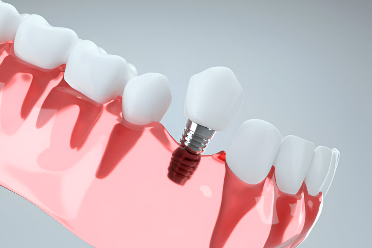 Dental Implant Myths
