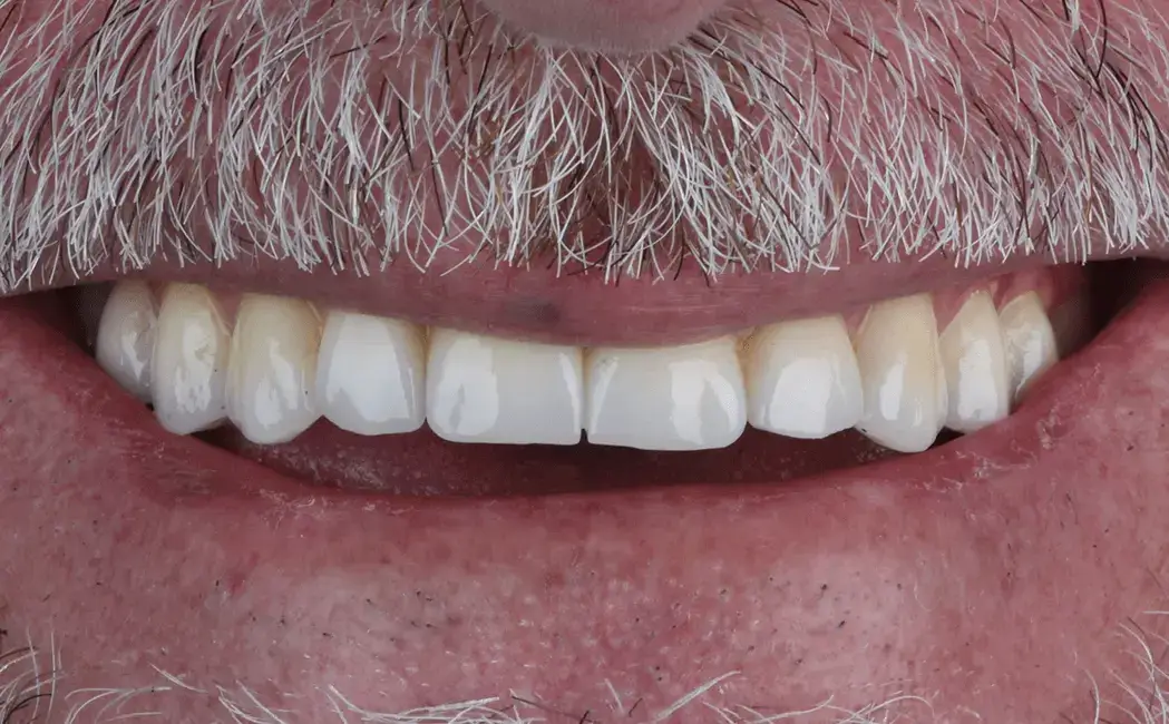 After cosmetic dentistry