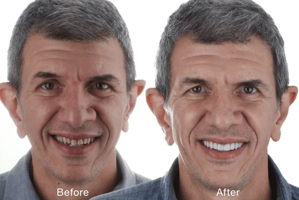 Miami cosmetic dentist veneers after 50