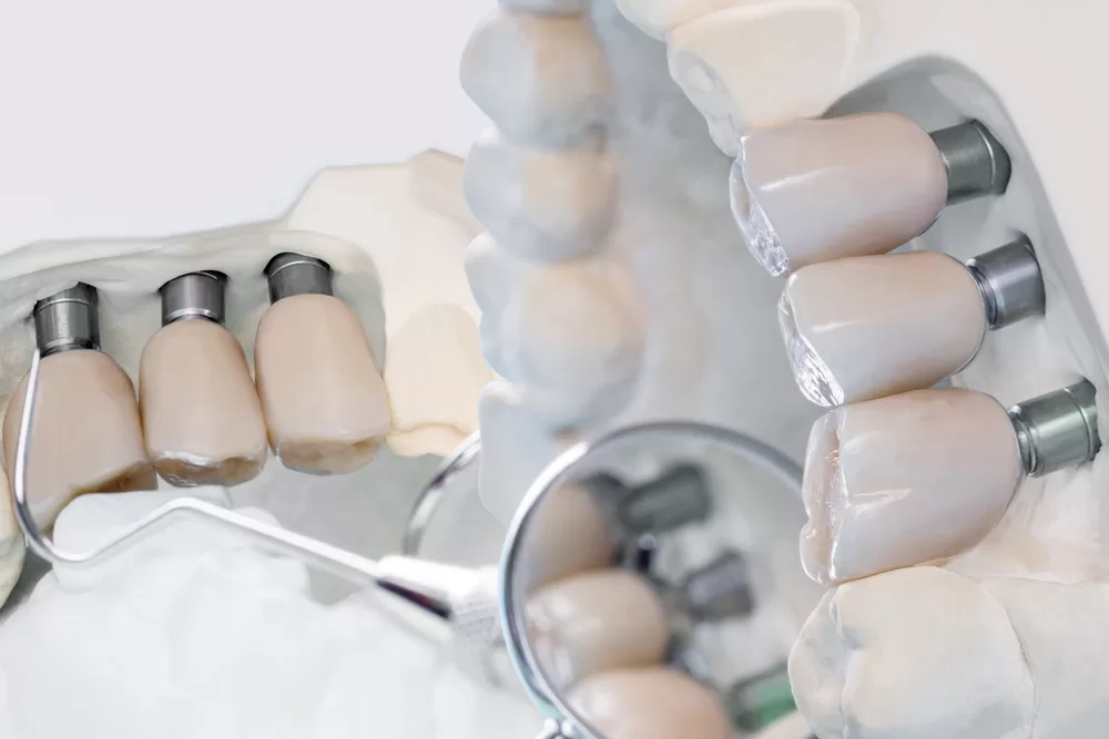 dental implants in Miami fl