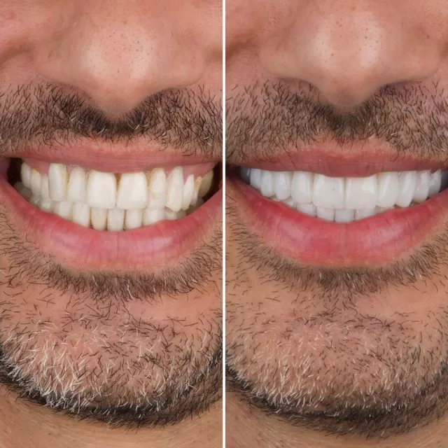 Consulta para carillas dentales